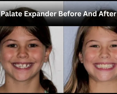 Palate Expander Before And After